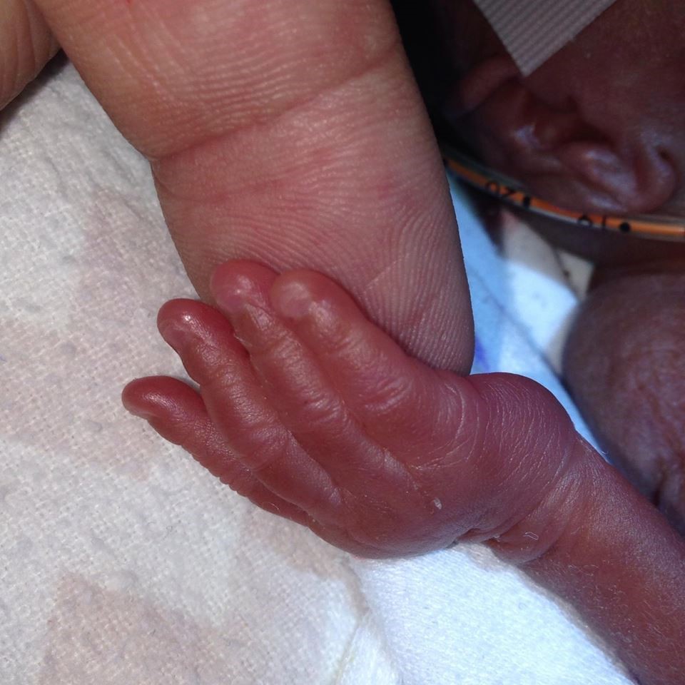 Photo: Dr. Tackman's fingertip under a premature infant's hand (courtesy of Dr. Tackman)