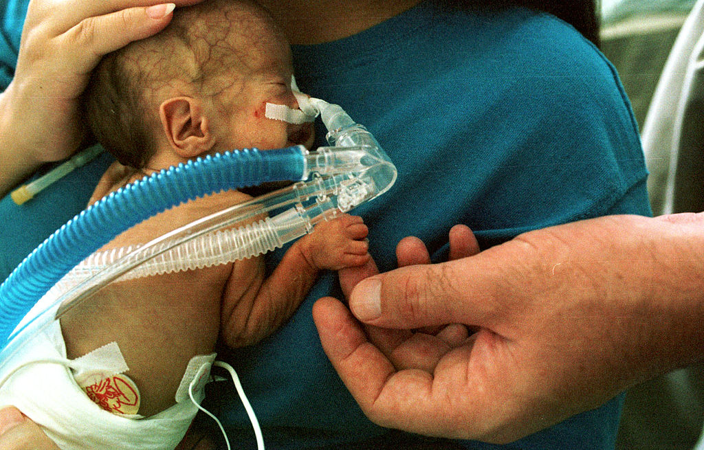 1024px-Premature_infant_CPAP_releasedtoPublicDomain_Wikimedia