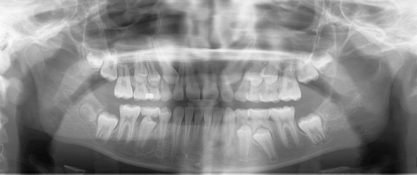 This X-ray from the mouth of a 9-year-old shows how the adult teeth grow below the baby teeth, embedded in the jawbone. (Image Credit: <a href="https://commons.wikimedia.org/wiki/File:Mixed_dentition_pan.jpg">Coronation Dental Specialty Group</a>)