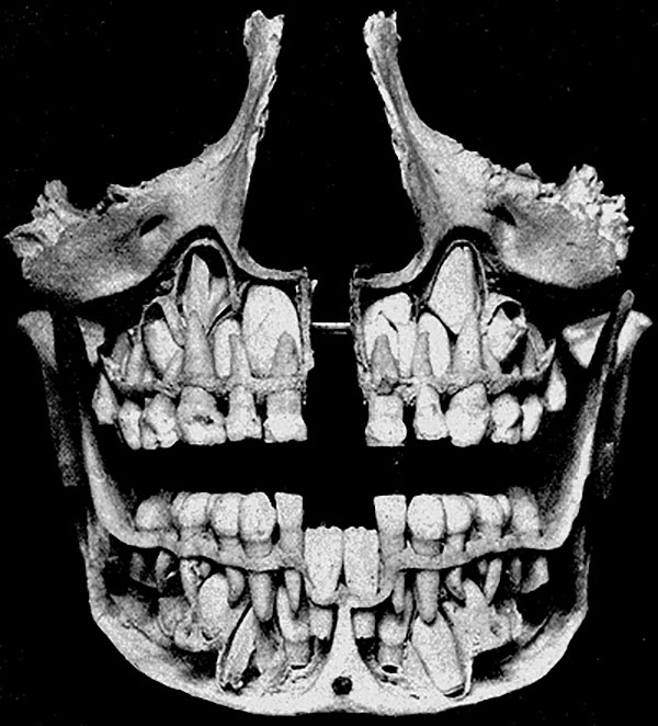 humans with multiple rows of teeth