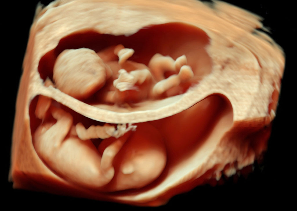 ultrasound twins