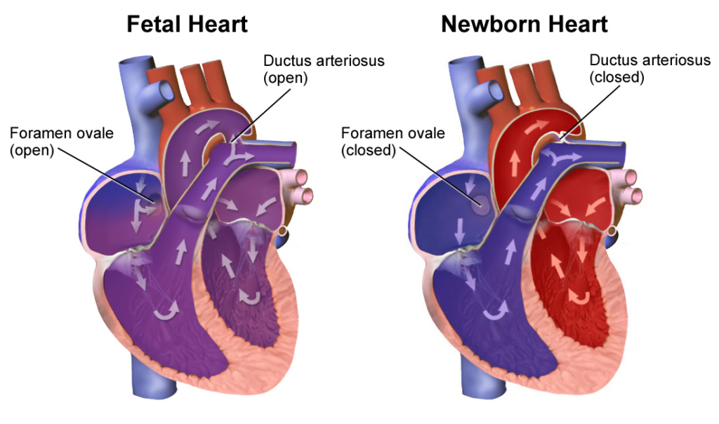 Side-by-side diagrams of a fetal heart and a newborn heart, highlighting Fetal circulation with open foramen ovale and ductus arteriosus, and neonatal circulation with these structures closed, to illustrate blood flow changes after birth.