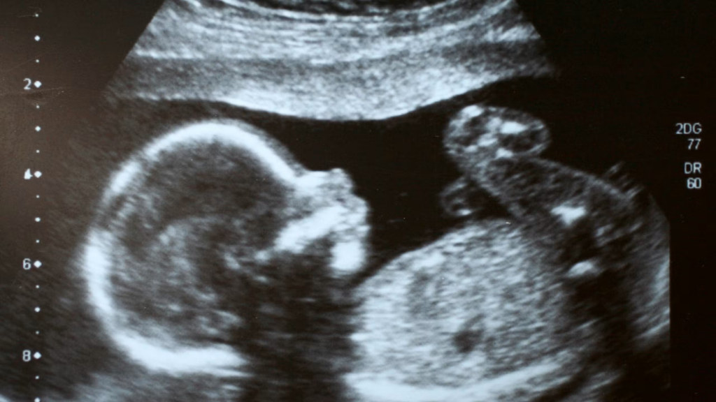 A grayscale ultrasound image shows the side profile of a developing baby in the womb, with the head, torso, and limbs visible.