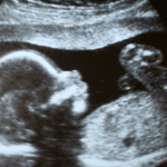 A grayscale ultrasound image shows the side profile of a developing baby in the womb, with the head, torso, and limbs visible.