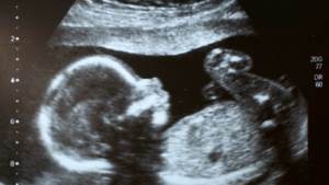 A grayscale ultrasound image shows the side profile of a developing baby in the womb, with the head, torso, and limbs visible.