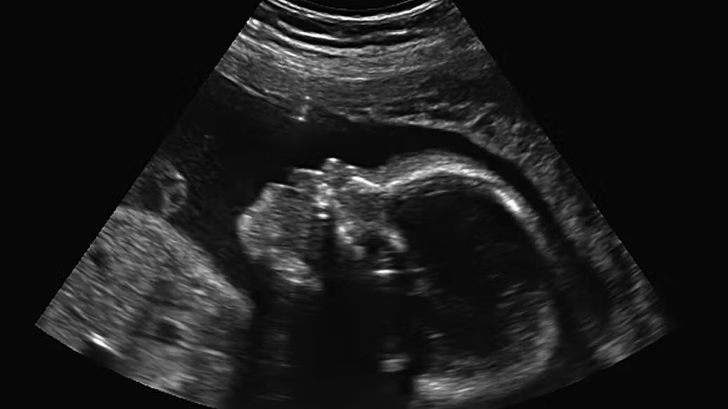 Ultrasound image showing the side profile of a human baby